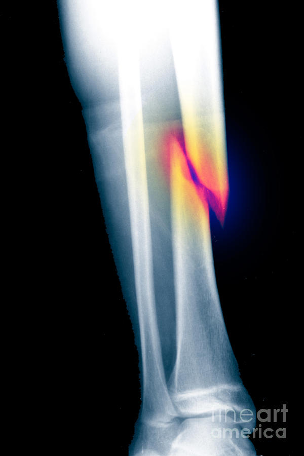 X-ray Of Fractured Tibia #1 Photograph by Scott Camazine