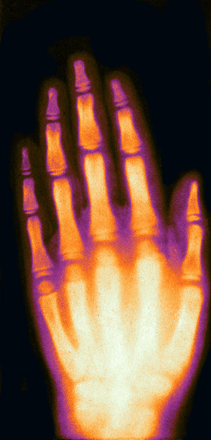 X-ray Of Girls Hand, 1896 #1 Photograph by Science Source