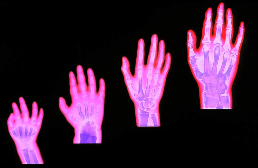 X-ray Of Hand Bone Growth: Child To Adult #1 Photograph by Science Photo Library
