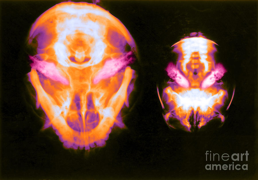 X-ray Of Inner Ear, Adult And Newborn #2 Photograph by Biophoto Associates