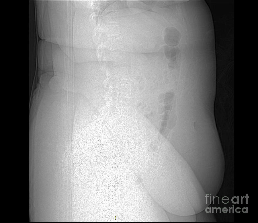 Science Photograph - X-ray Of Morbidly Obese Patient #1 by Living Art Enterprises