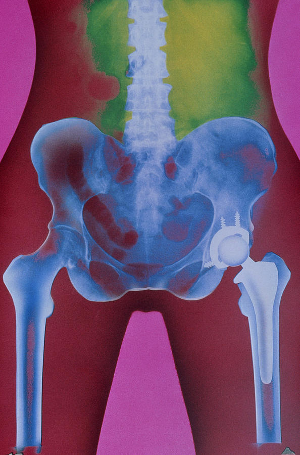 X-ray Of Prosthetic Hip #1 Photograph by Chris Bjornberg