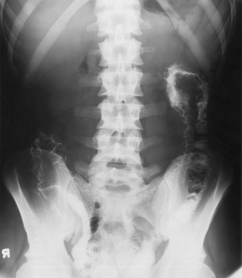 Xrays Spine