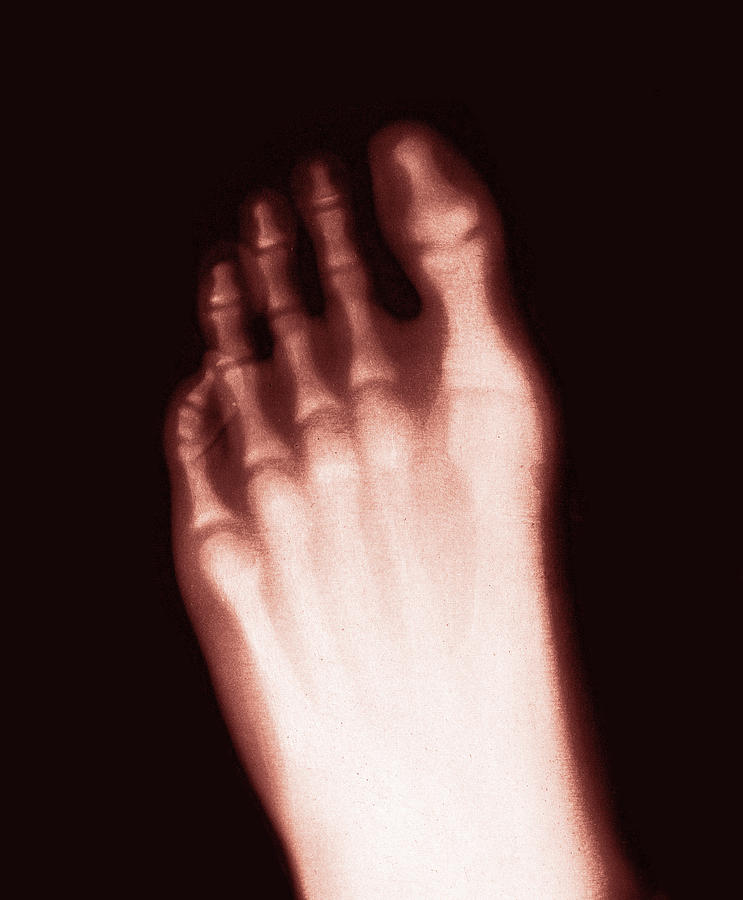 X-ray Of Teenage Boys Foot, 1896 #1 Photograph by Science Source