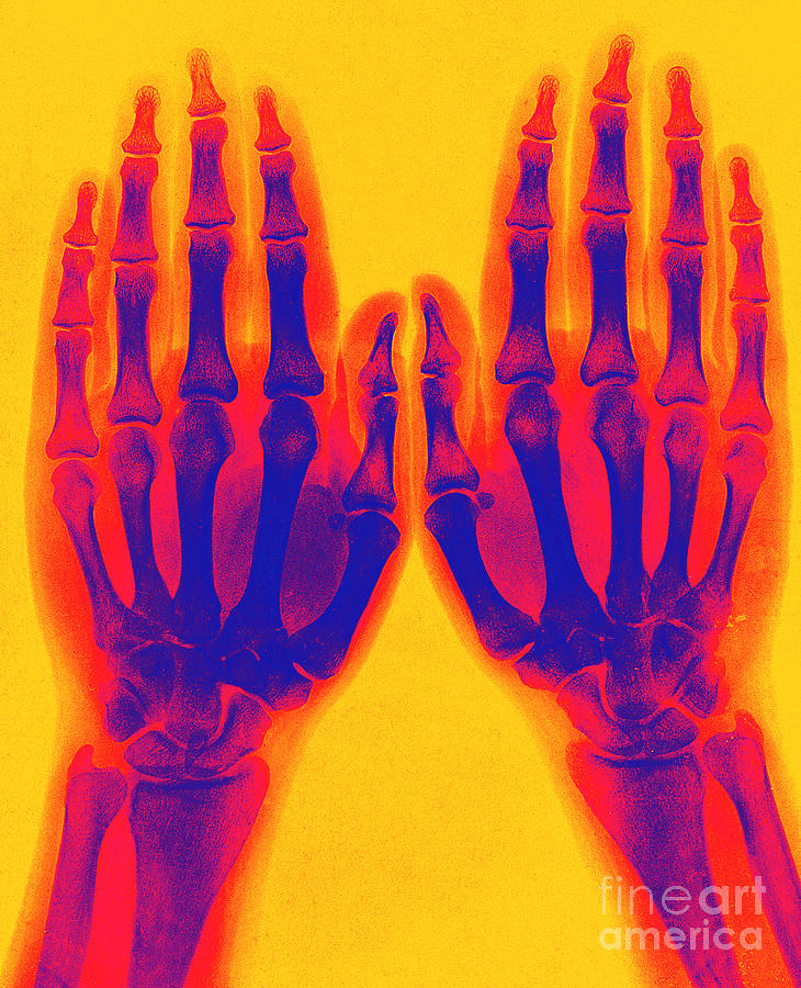 X-ray Of Two Normal Hands 1896 #3 Photograph by Science Source