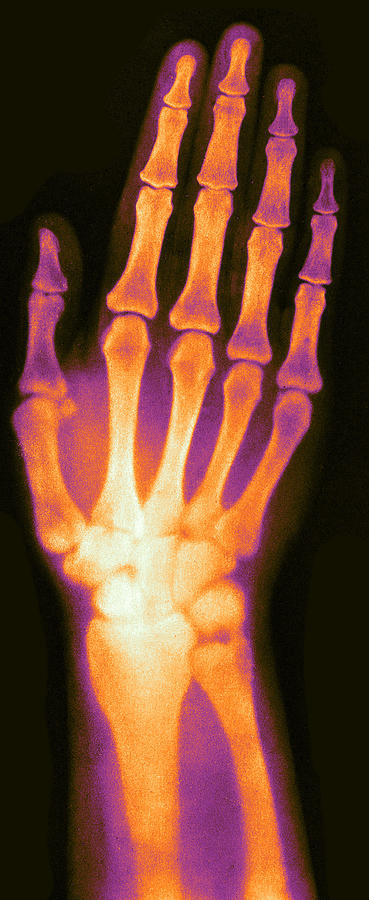 X-ray Of Womans Hand, 1896 #1 Photograph by Science Source