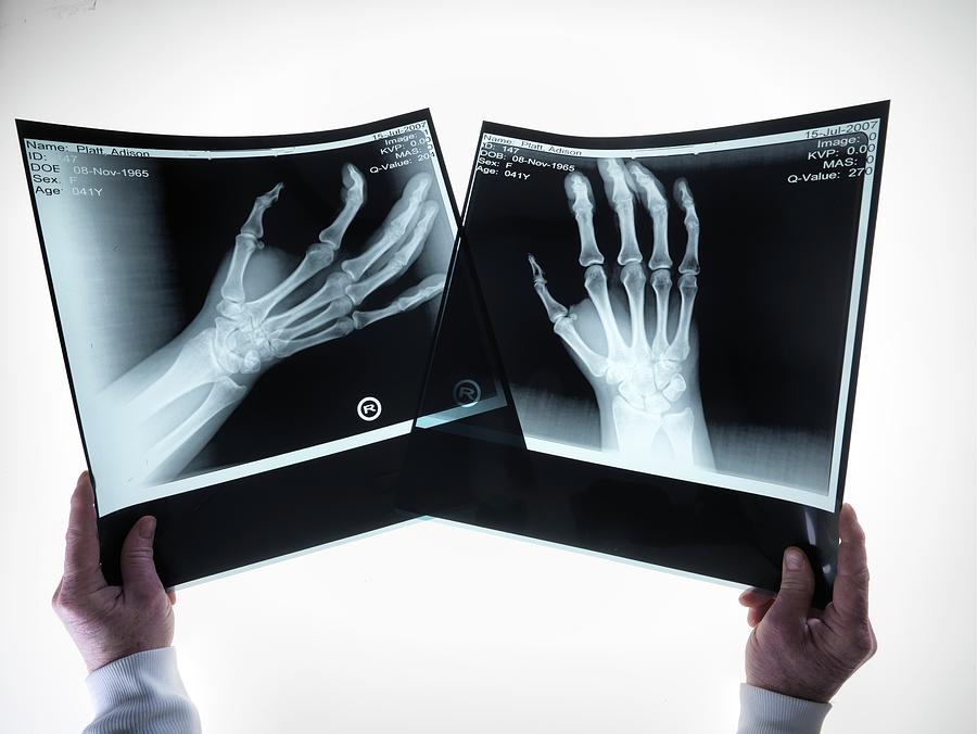 Adult Photograph - X-rays Of Hands #1 by Tek Image