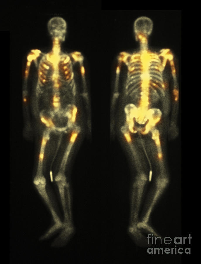 Bone Scan Showing Multiple Metastases #10 Photograph by Scott Camazine