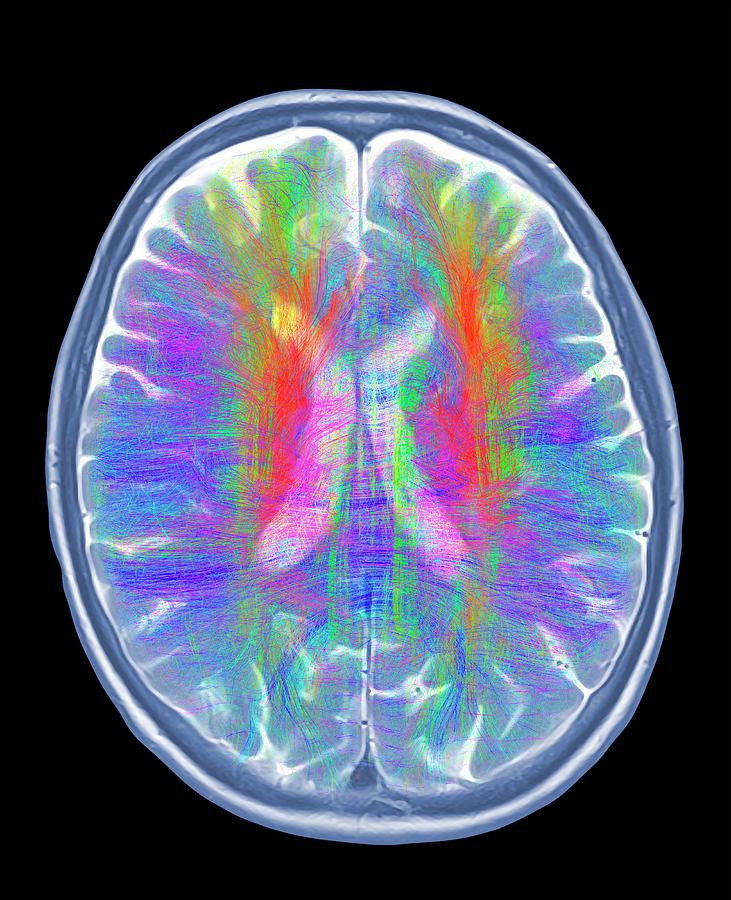 Brain Mri And White Matter Fibres #10 Photograph by Alfred Pasieka/science Photo Library