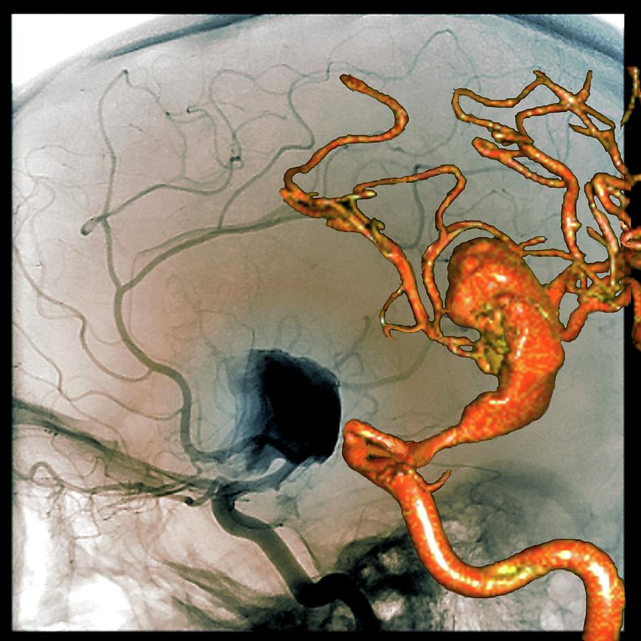 Cerebral Aneurysm 10 Photograph By Zephyr Science Photo Library Fine Art America