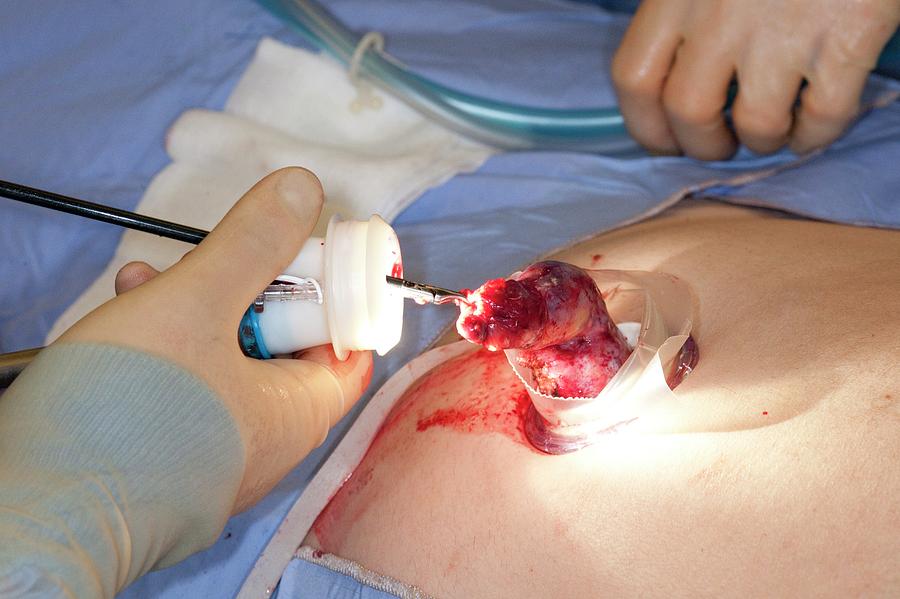 how long is the operation to remove gallbladder