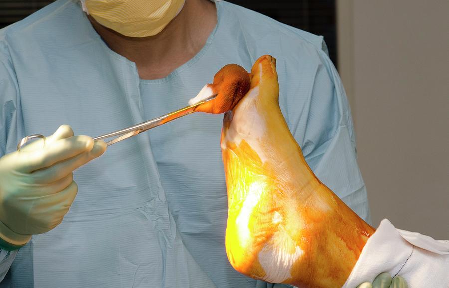 Knee Replacement Surgery Photograph by Dr P. Marazzi