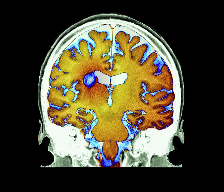 Multiple Sclerosis #10 Photograph by Zephyr/science Photo Library