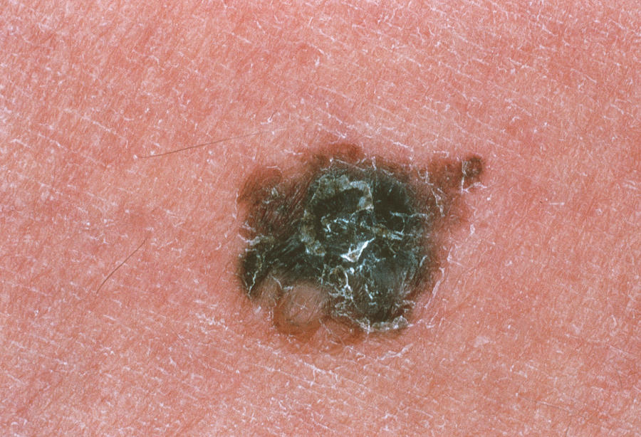 Skin Cancer #10 Photograph by Cnri/science Photo Library