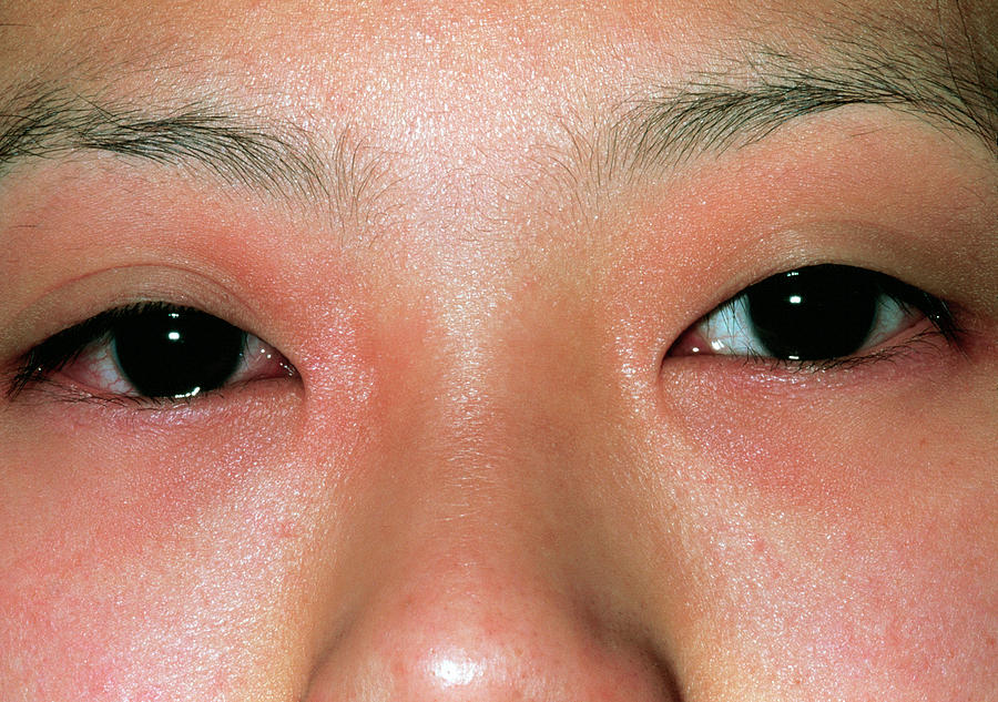 Allergic Conjunctivitis Photograph By Dr P Marazziscience Photo Library 