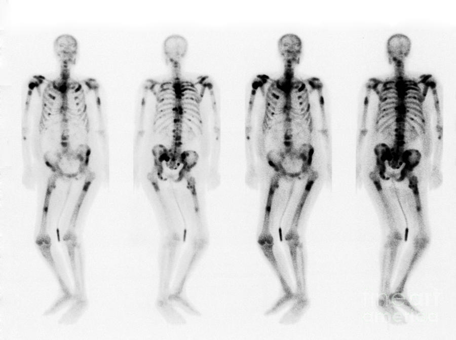 Bone Scan Showing Multiple Metastases #11 Photograph by Scott Camazine