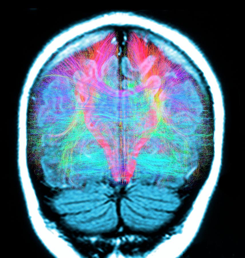 Brain Mri And White Matter Fibres #11 Photograph by Alfred Pasieka/science Photo Library