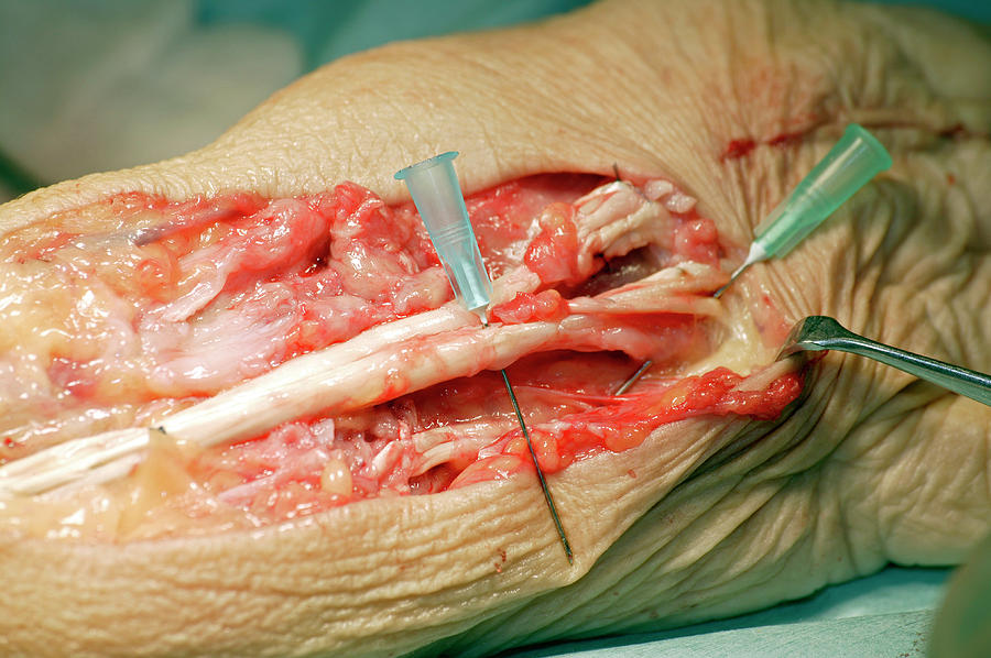 Carpal Tunnel Syndrome Surgery #11 Photograph by Antonia Reeve/science Photo Library