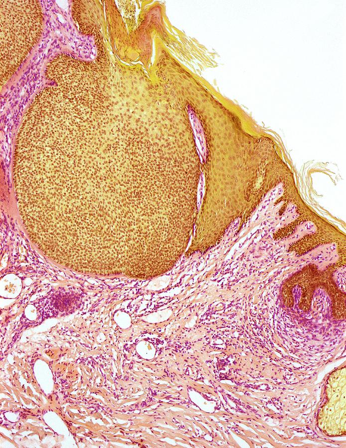 Rodent Ulcer Photograph - Skin Cancer #11 by Steve Gschmeissner
