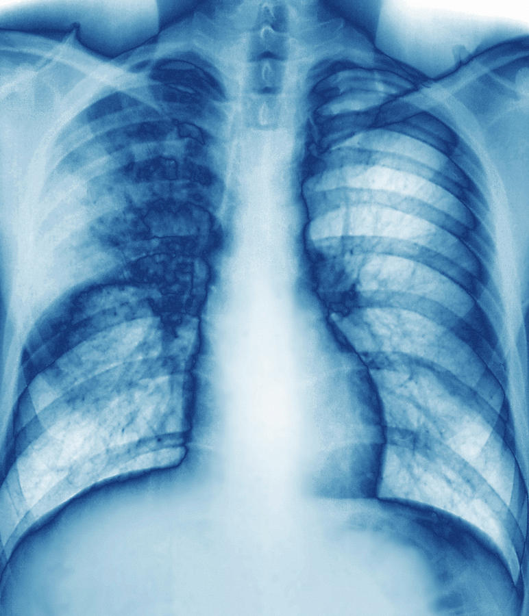 Tuberculosis Photograph by Zephyr/science Photo Library - Fine Art America