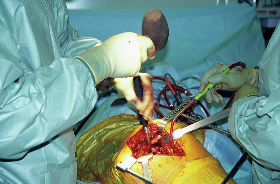 Hip Replacement Surgery #12 Photograph by Antonia Reeve/science Photo Library