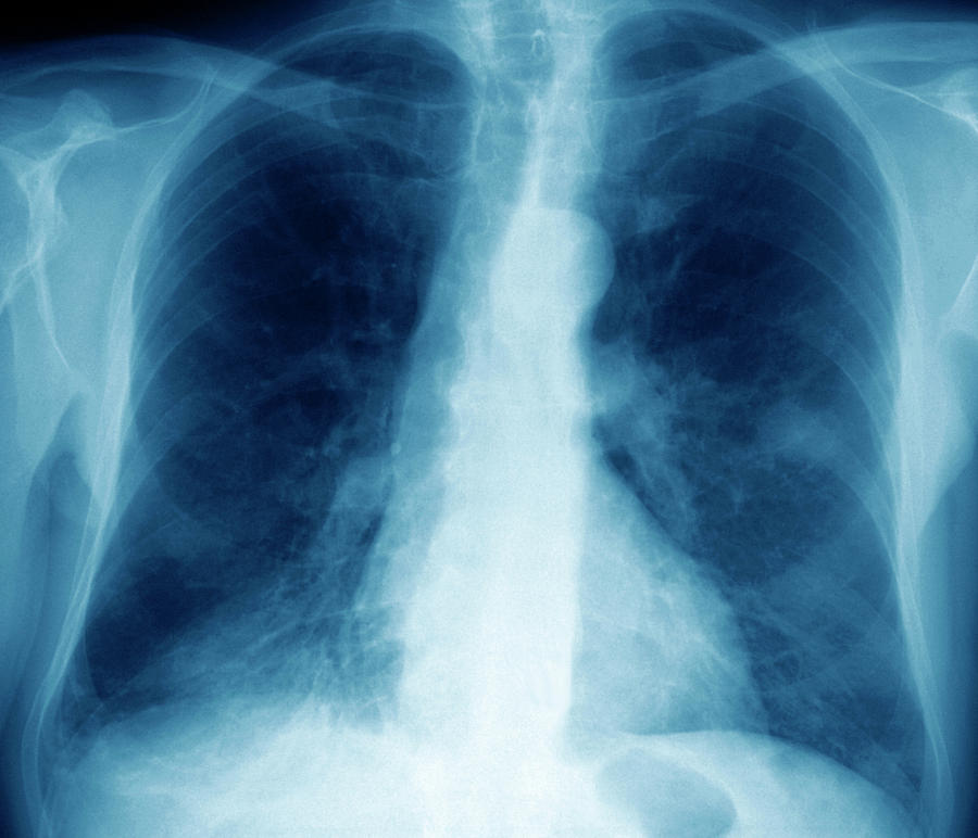 Organ Photograph - Lung Cancer #12 by Zephyr/science Photo Library