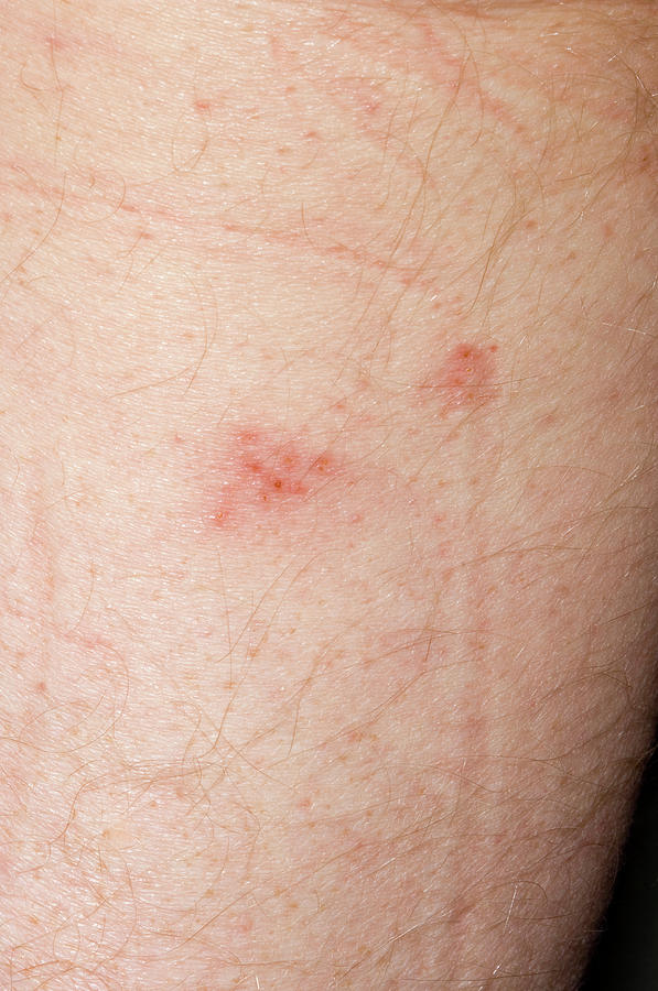 Shingles Rash Photograph by Dr P. Marazzi/science Photo Library