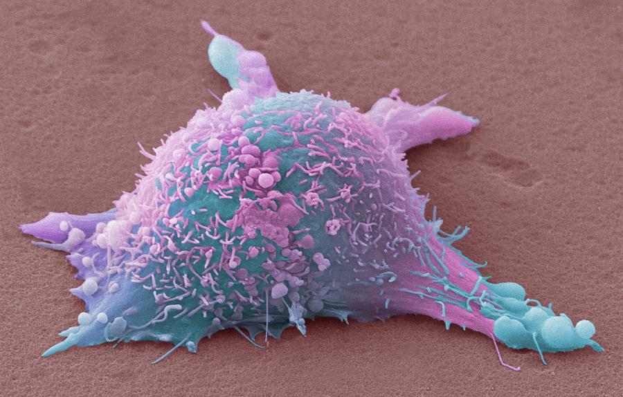 Skin Cancer Cell Photograph by Steve Gschmeissner | Fine Art America