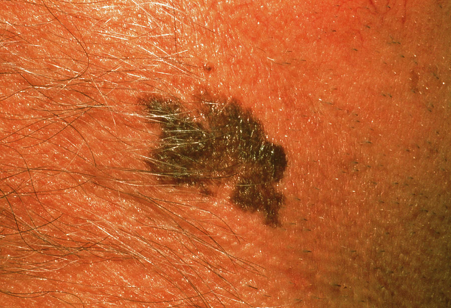 Skin Cancer #12 Photograph by Cnri/science Photo Library