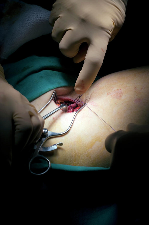 Tool Photograph - Varicose Vein Surgery #12 by Jim Varney/science Photo Library