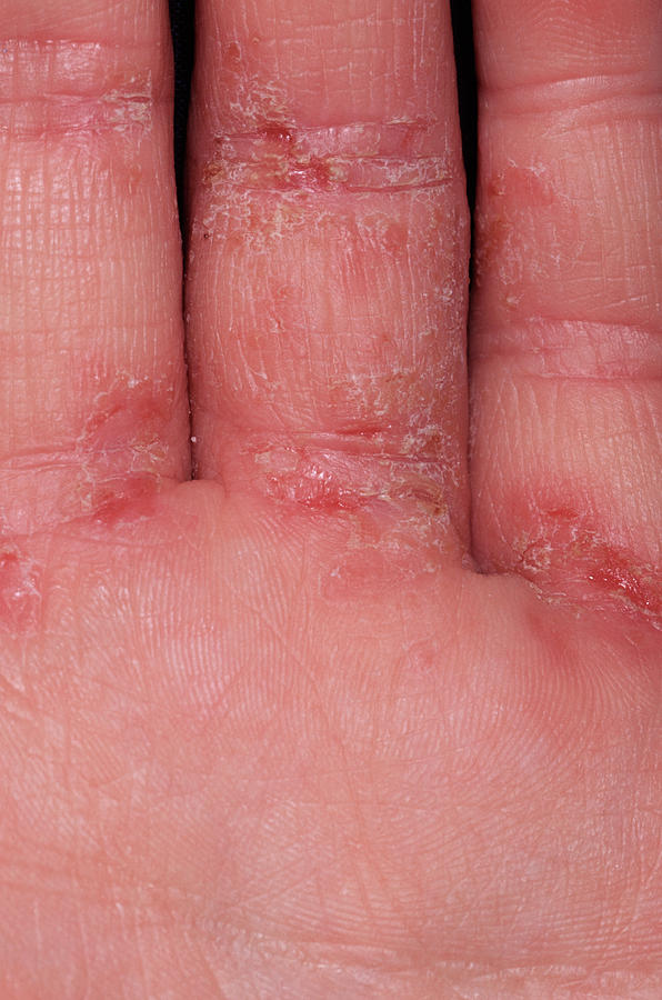 Eczema Photograph By Dr P Marazziscience Photo Library