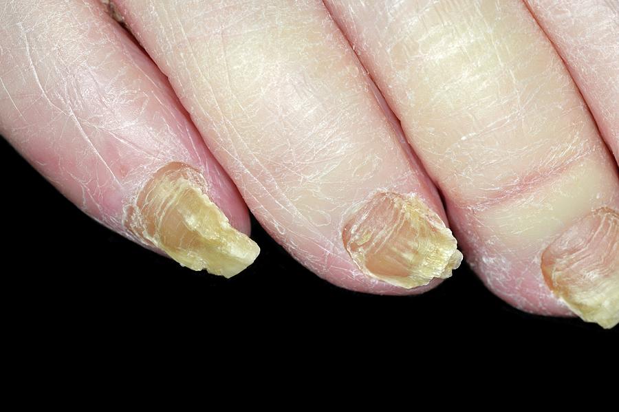 Fungal Nail Infection Photograph By Dr P Marazzi science Photo Library