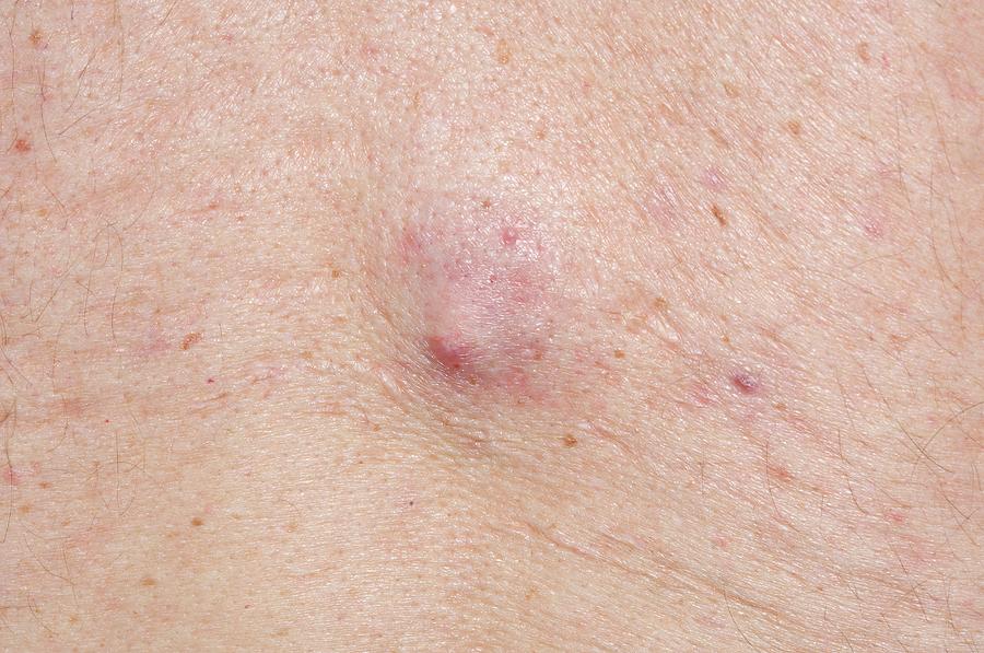 Sebaceous Cyst 5313