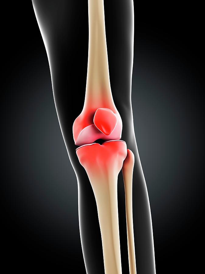 Knee Pain #13 Photograph by Sciepro/science Photo Library
