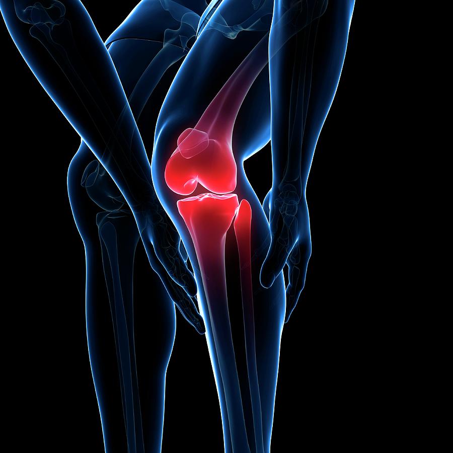 Painful Knee Photograph by Sciepro/science Photo Library | Pixels