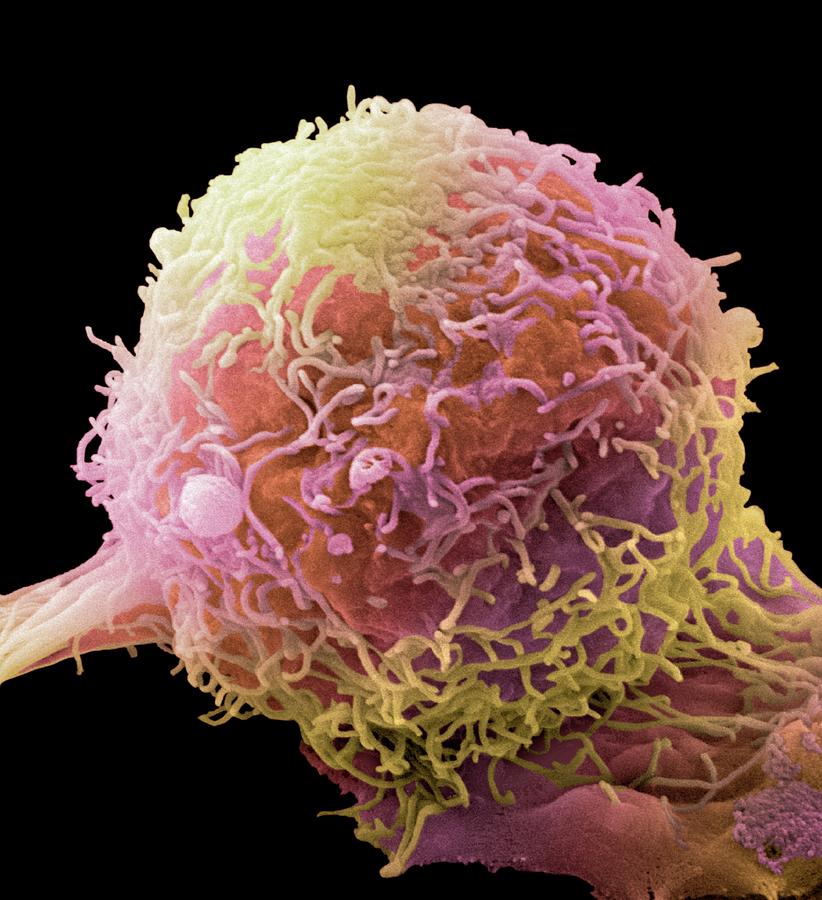 Skin Cancer Cell Photograph by Steve Gschmeissner - Pixels