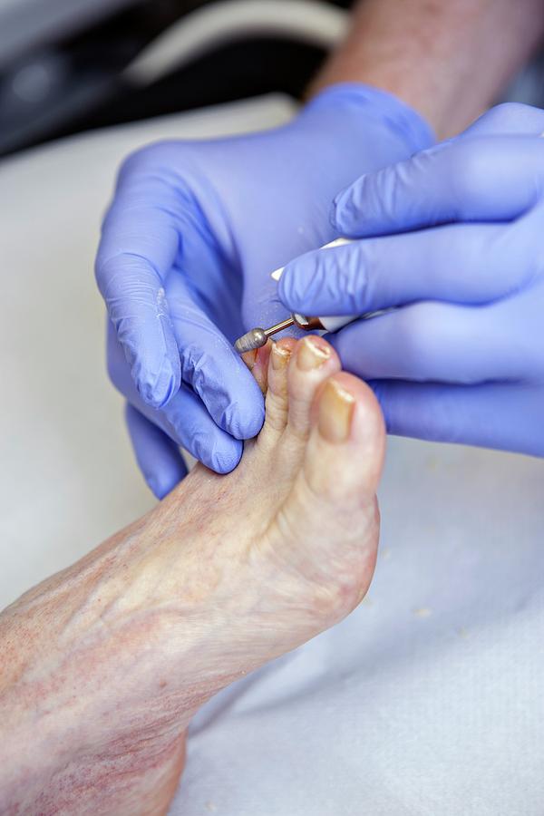 Chiropody Treatment Photograph by Lewis Houghton/science Photo Library ...