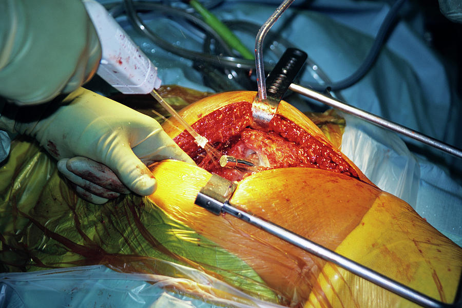 Hip Replacement Surgery #14 Photograph by Antonia Reeve/science Photo Library