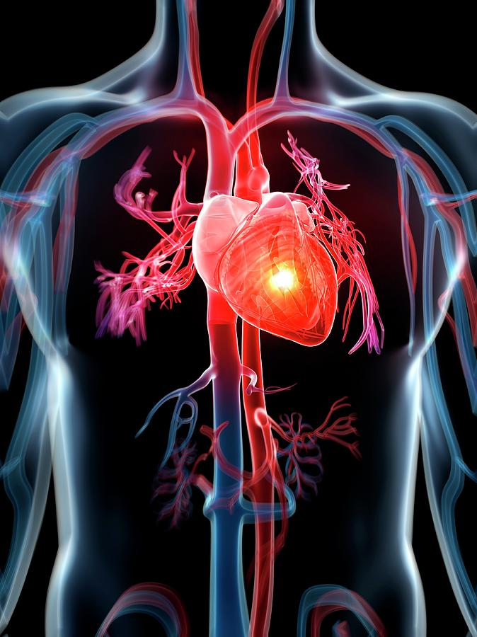 Illustration Photograph - Human Heart Attack #14 by Sebastian Kaulitzki