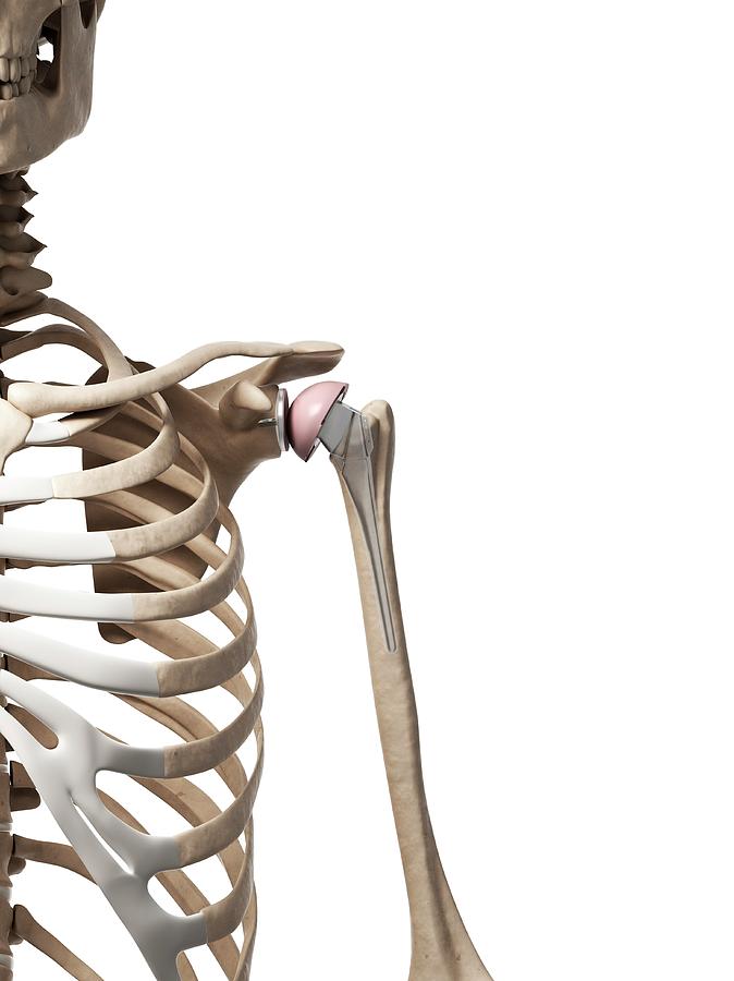 Skeleton Photograph - Human Shoulder Replacement #14 by Sebastian Kaulitzki