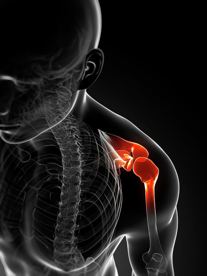 Shoulder Pain #14 Photograph by Sciepro/science Photo Library - Pixels