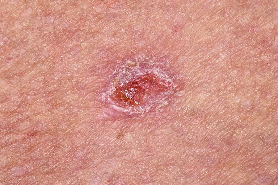 15 Basal Cell Carcinoma Skin Cancer Dr P Marazziscience Photo Library 
