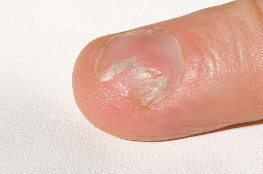 Fungal Nail Infection Photograph by Dr P. Marazzi/science Photo Library