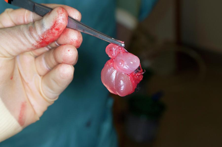 Epididymal Cyst Removal Surgery Photograph By Dr P Marazzi/science 