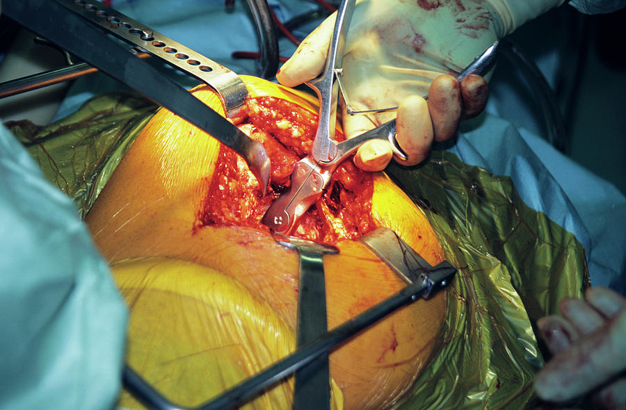 Hip Replacement Surgery #16 Photograph by Antonia Reeve/science Photo Library