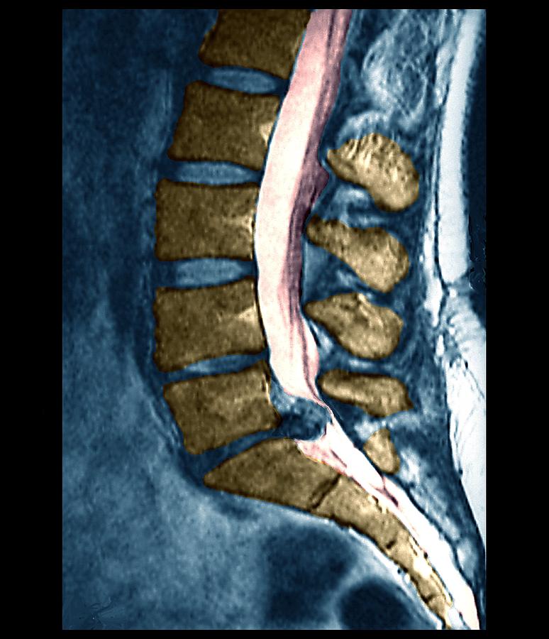 Slipped Disc #16 by Zephyr/science Photo Library