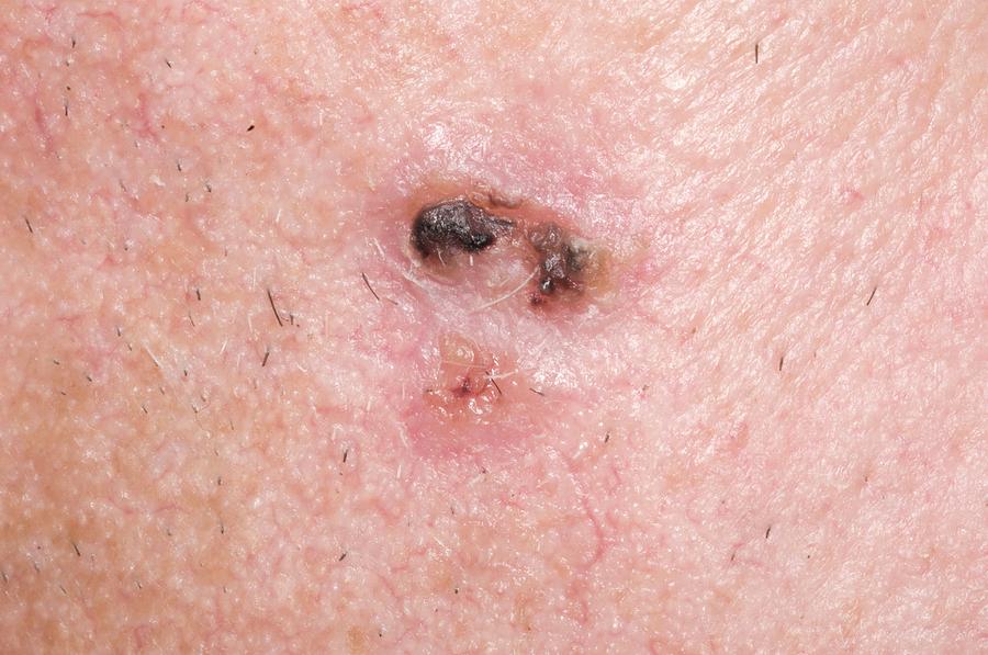 Basal Cell Carcinoma Photograph By Dr P Marazziscience Photo Library 1402