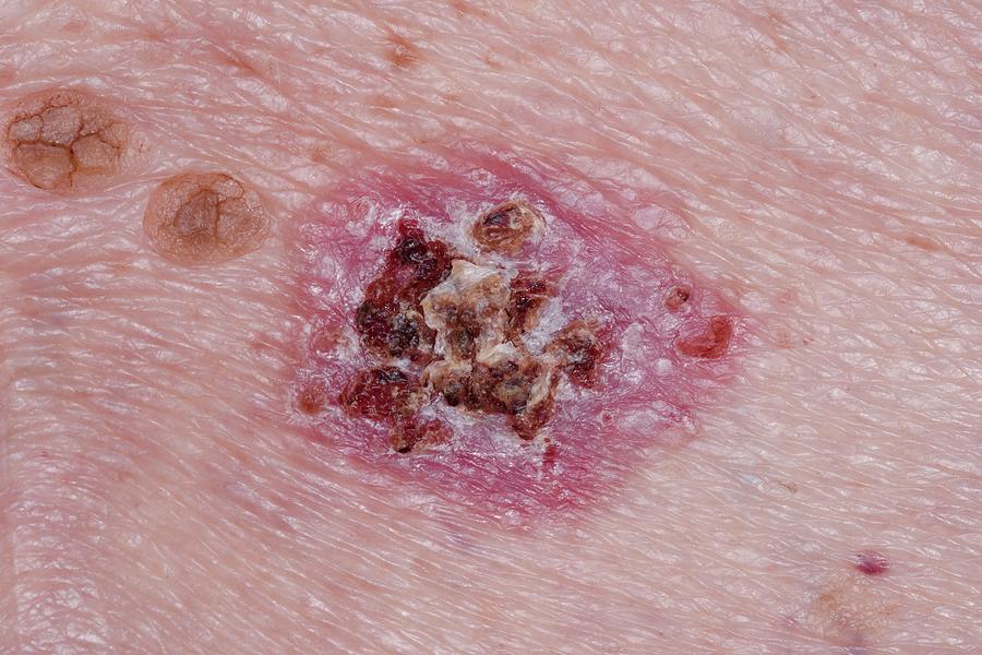 17 Basal Cell Carcinoma Skin Cancer Dr P Marazziscience Photo Library 