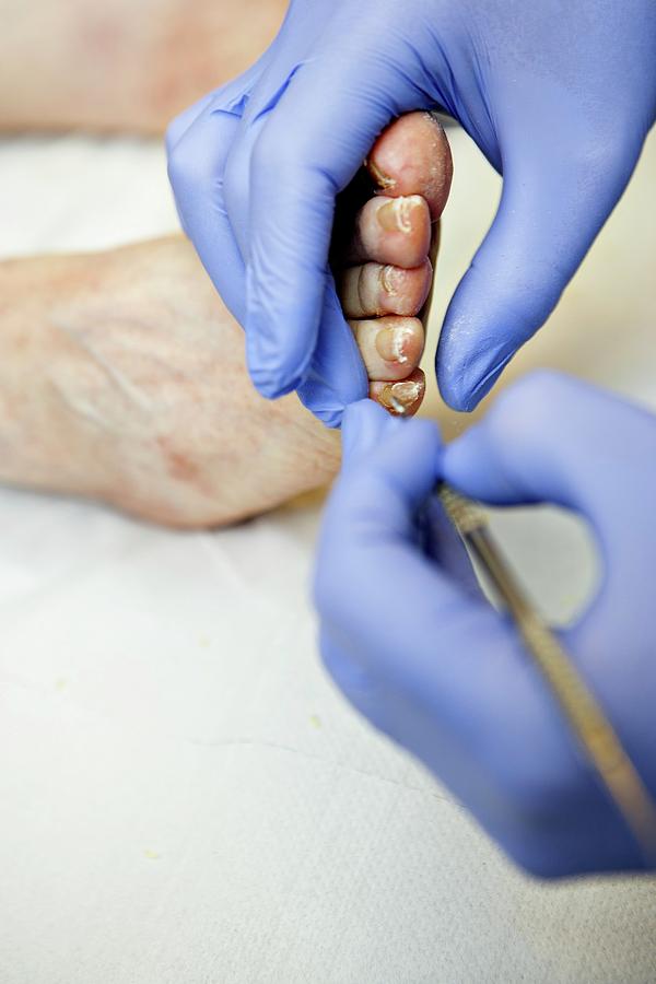 Chiropody Treatment Photograph by Lewis Houghton/science Photo Library ...