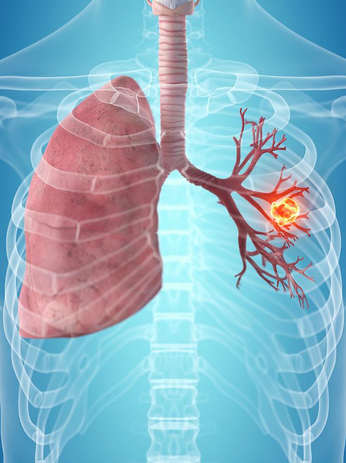 Human Lungs #18 by Sciepro